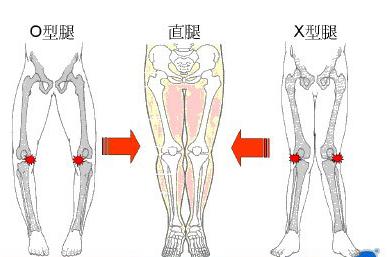 5种走路姿势会让你变成O型腿 走路姿势能改变o型腿吗