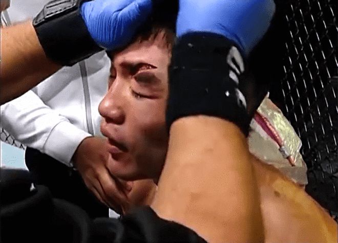 UFC头条主赛宋亚东因伤口太重不敌对手 无缘世界前五