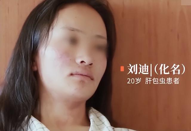 19年一藏族女孩患上虫癌，医生开刀一看，肝脏爬满整整2斤的虫子