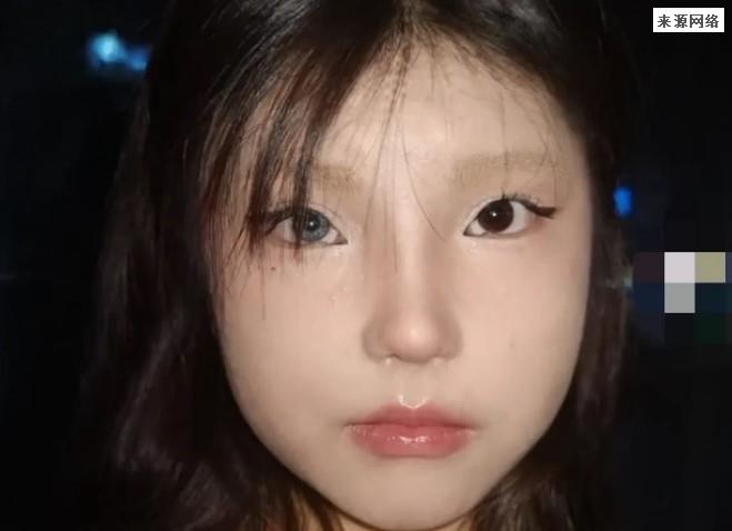 18岁女孩右眼天生蓝瞳被视为异类，这是虹膜异色症