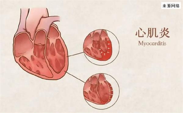 感染新冠引发的心肌炎有什么反应
